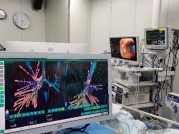 Interventional pulmonology procedure